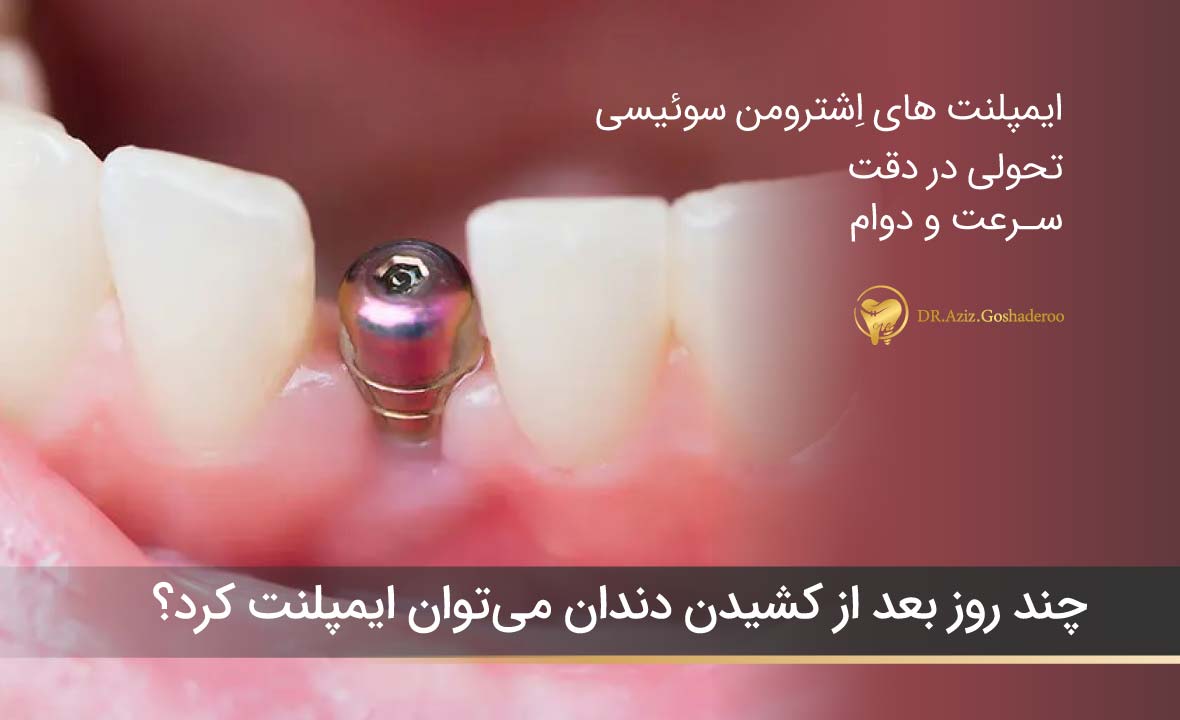 چند روز بعد از کشیدن دندان میتوان ایمپلنت کرد؟ (زمان طلایی کاشت دندان)